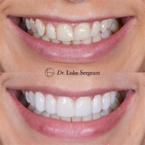 composite teeth veneers|Long.